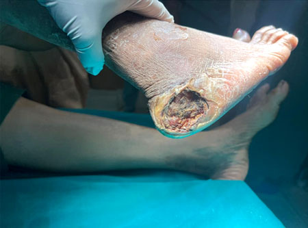 Best Doctor For Gangrene Treatment Thane