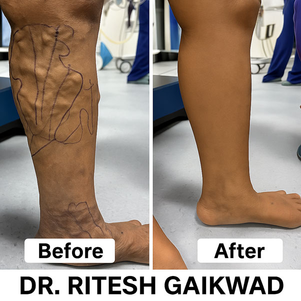 Best Laser Varicose Veins Treatment in Thane - Dr. Ritesh Gaikwad
