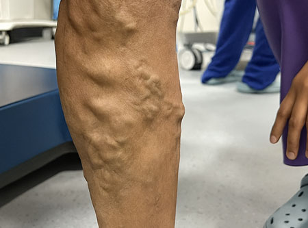 Laser Varicose Vein Treatment in Thane