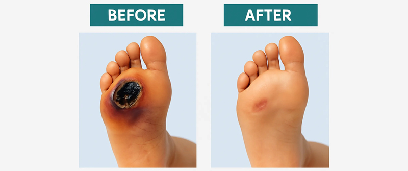 Diabetic foot gangrene treatment by Dr. Ritesh Gaikwad – Vascular Surgeon in Thane, Ghodbunder road, Hiranandani estate, Vasanth Vihar Thane and Mumbai