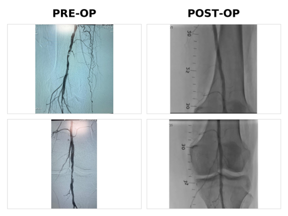 ABI + Doppler evaluation for PAD & gangrene diagnosis