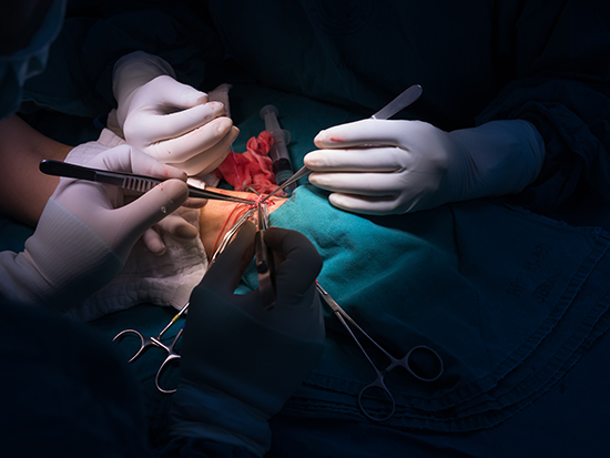 Av Fistula For Dialysis Repair in Thane