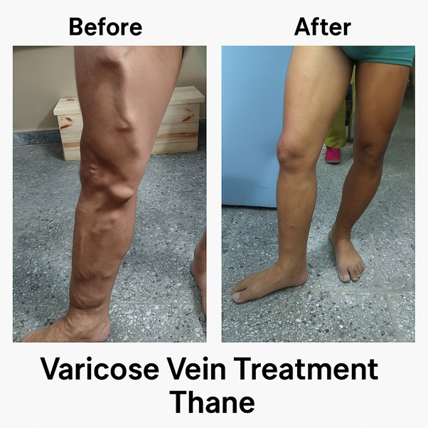 Varicose Veins Treatment in Thane