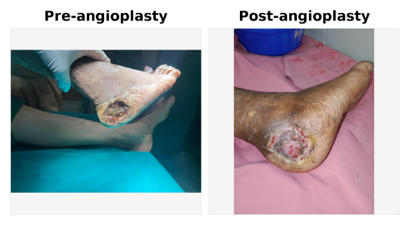 Infection control with limb-saving debridement – Dr. Ritesh Gaikwad