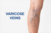 Varicose Veins Surgeon in Thane