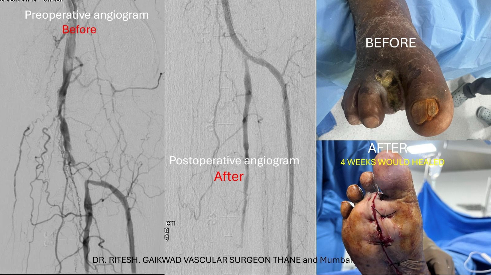 Dr. Ritesh Gaikwad Vascular surgeon and Endo Vascular surgeon